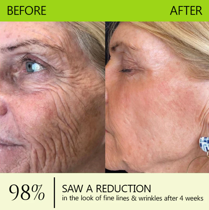[🔥Last Day 70% OFF] LELUMP™ Botox & Retinol Shot - Eraser for Deep Wrinkles, Sagging Jowls & Puffy Eyes